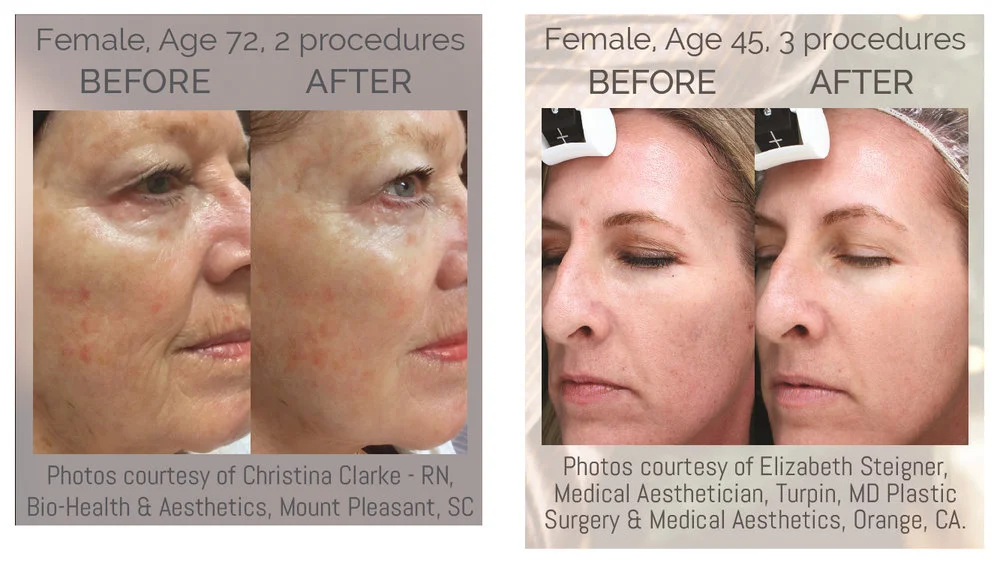 bellus-Before-and-after-1.jpg