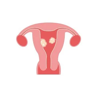 Fibroids: very common, sometimes problematic