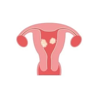 Fibroids: very common, sometimes problematic