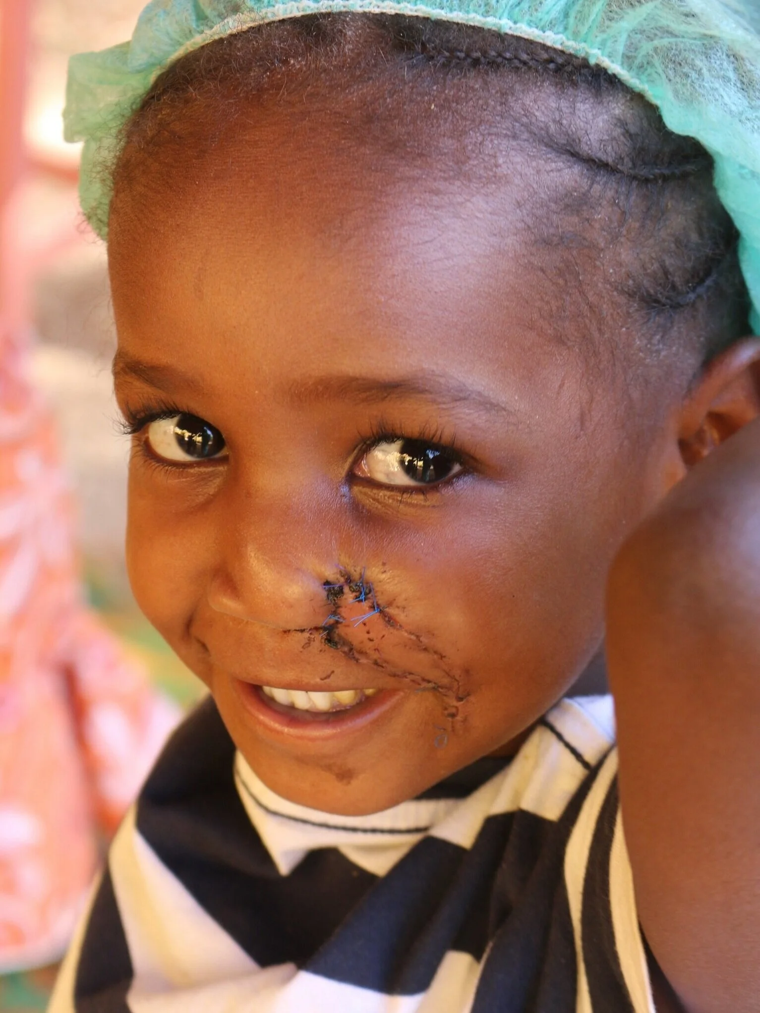 Mit der Hilfsaktion NOMA gegen die grausame Krankheit