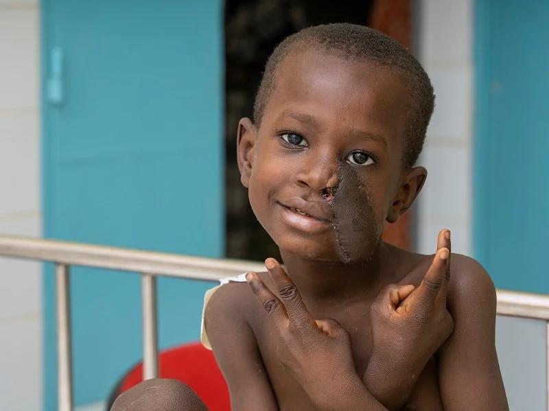 Enormous relief for noma children by enoral distractor