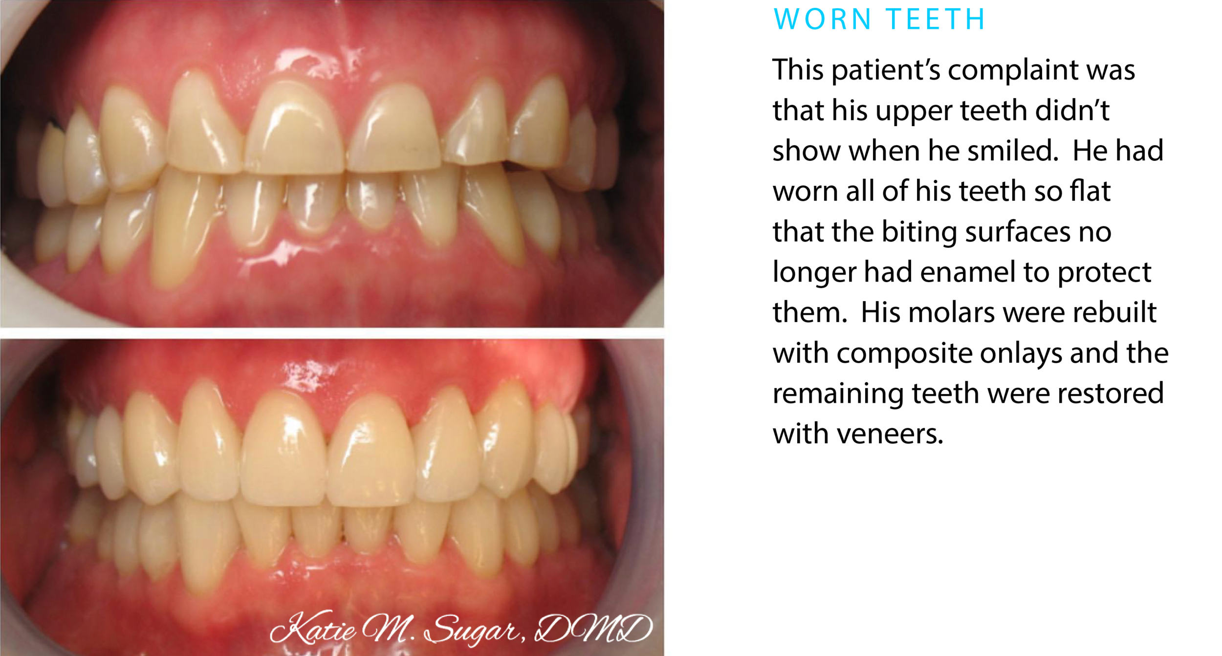 Oxnard-Dental-worn-teeth