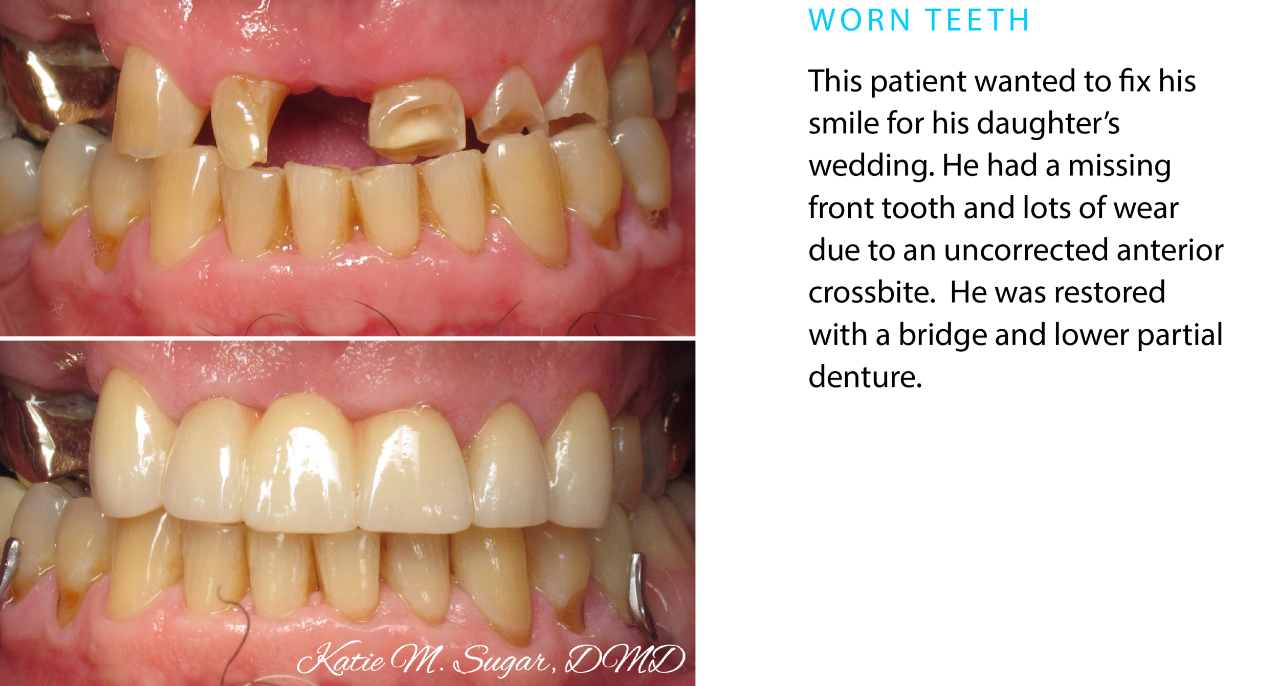 Dentist-Oxnard-Worn-Teeth