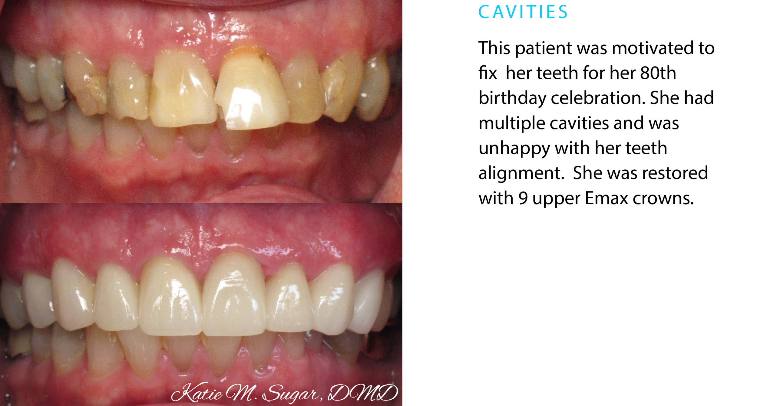dentist-oxnard-cavities