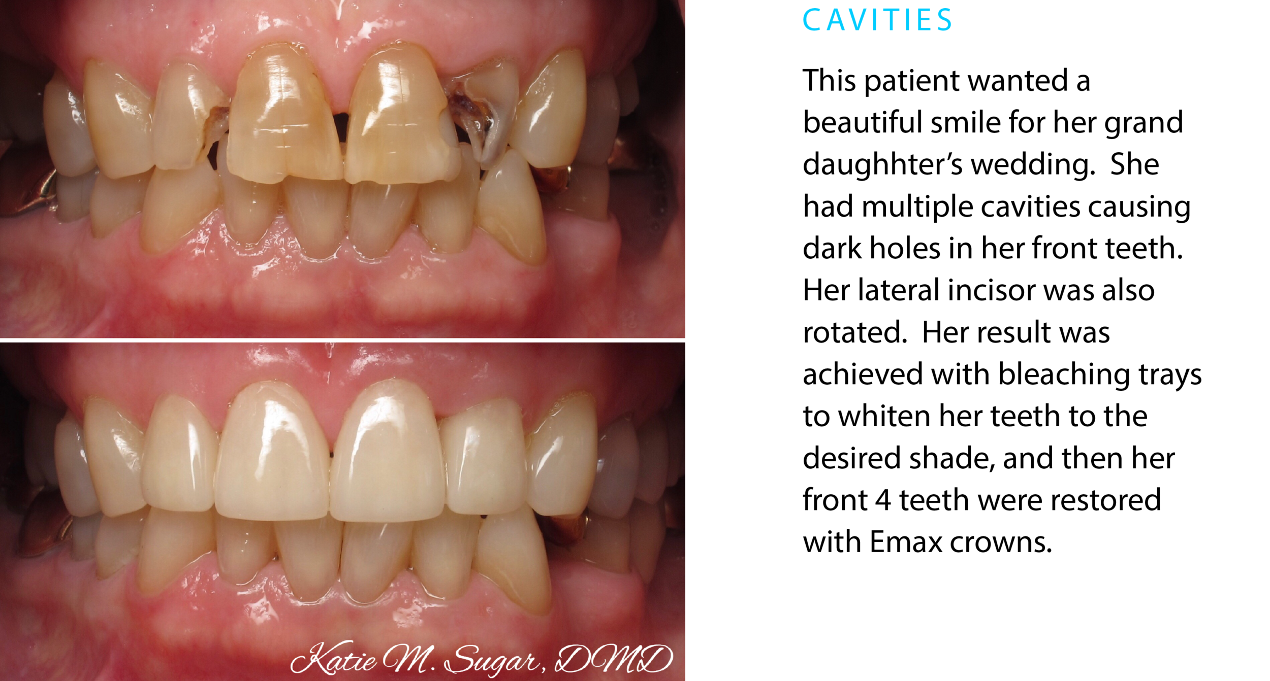 oxnard-family-dental-cavities