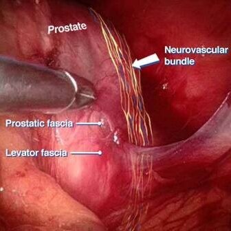 Nerve Sparing Robotic Prostatectomy