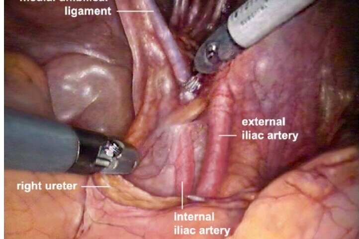 prostate cancer surgery)