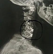My Anterior Cervical Spine Surgery Changed My Life