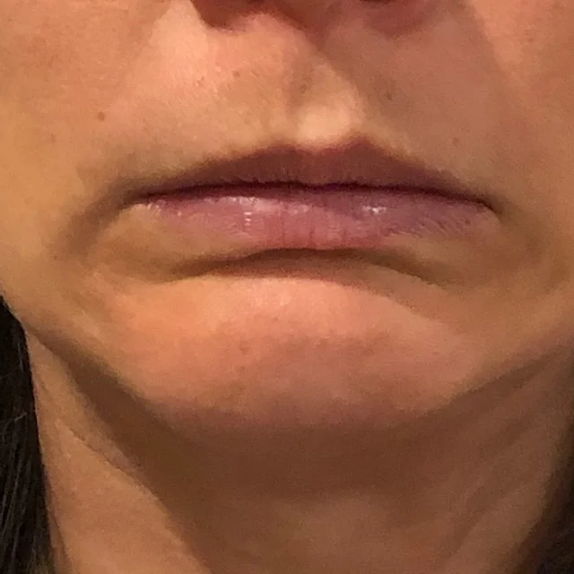 Depressor Anguli Oris Botox