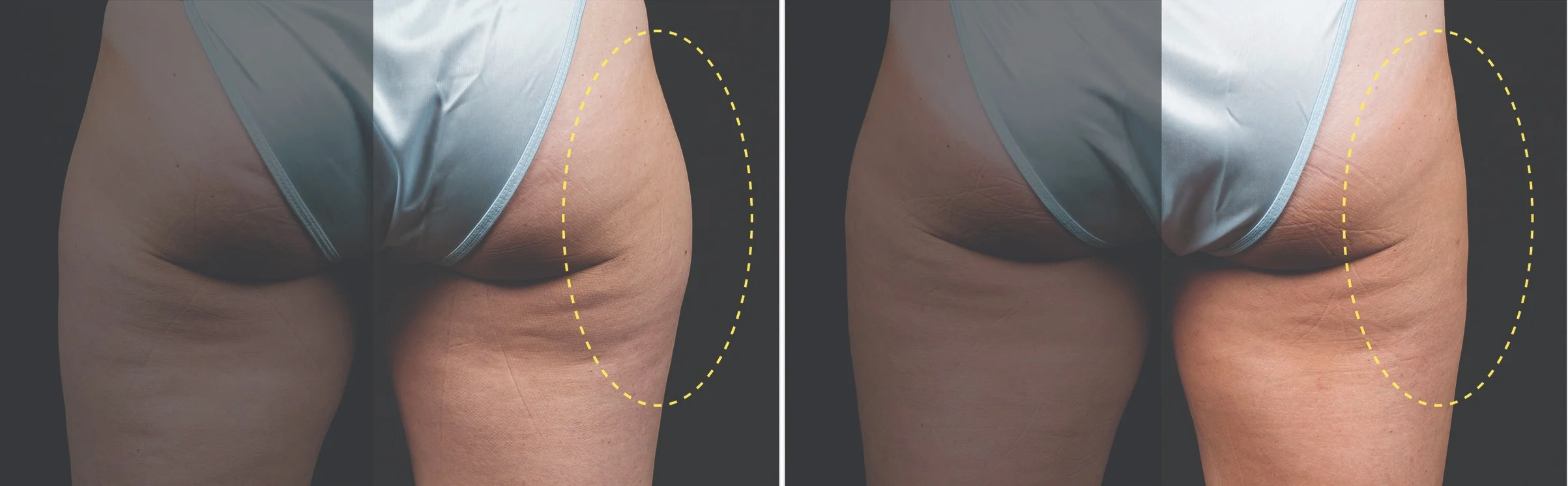 Female Outer Thigh (Single Side Treatment)