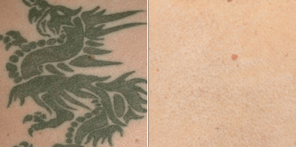 NonLaser Tattoo Removal in Lexington KY  Tatt2Away