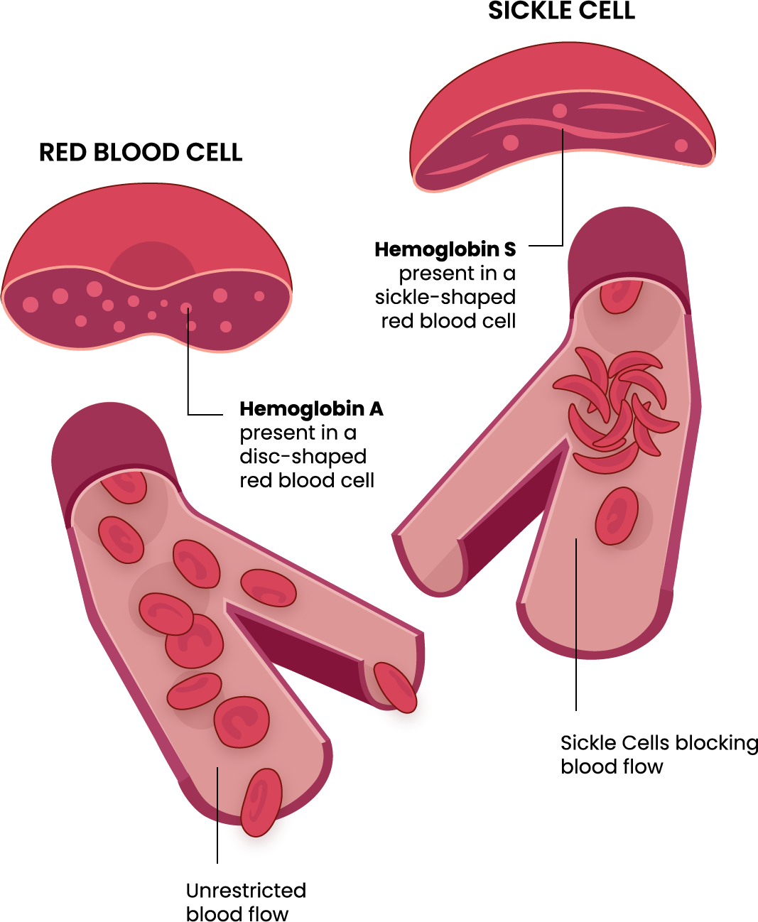 Sickle Cell Illustration-EN0.png