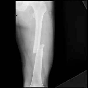 Broken femur
