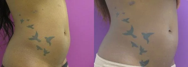 Liposuction before and after, Oblique Right