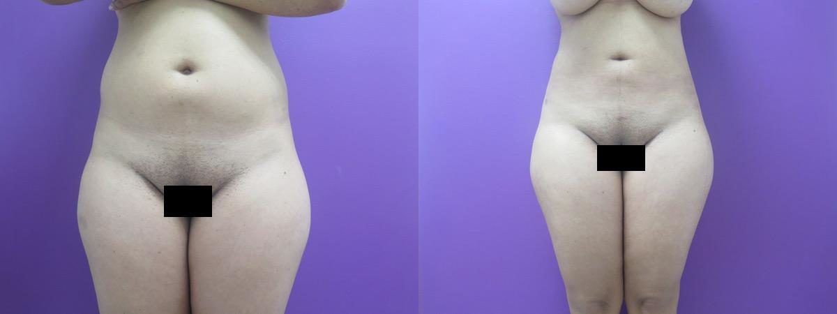 Liposuction before and after, Frontal