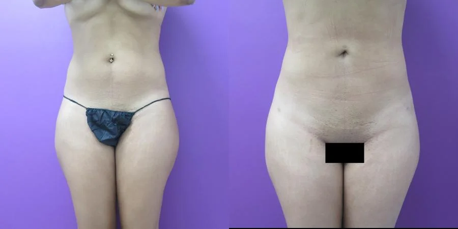 Liposuction before and after, Frontal