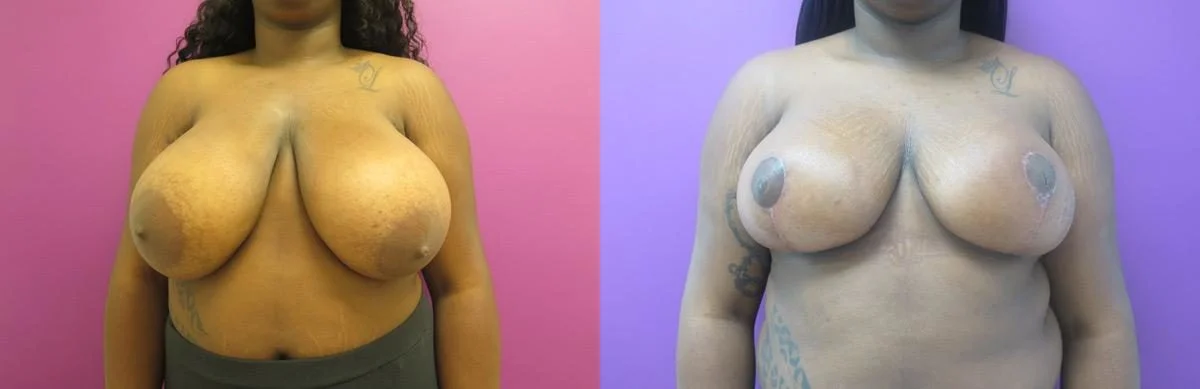 Breast Lift before and after, Frontal