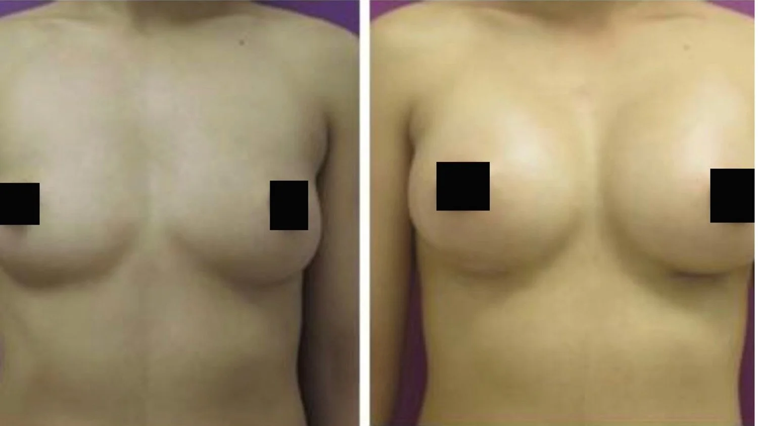 bef after breast aug 9 edited small.jpg
