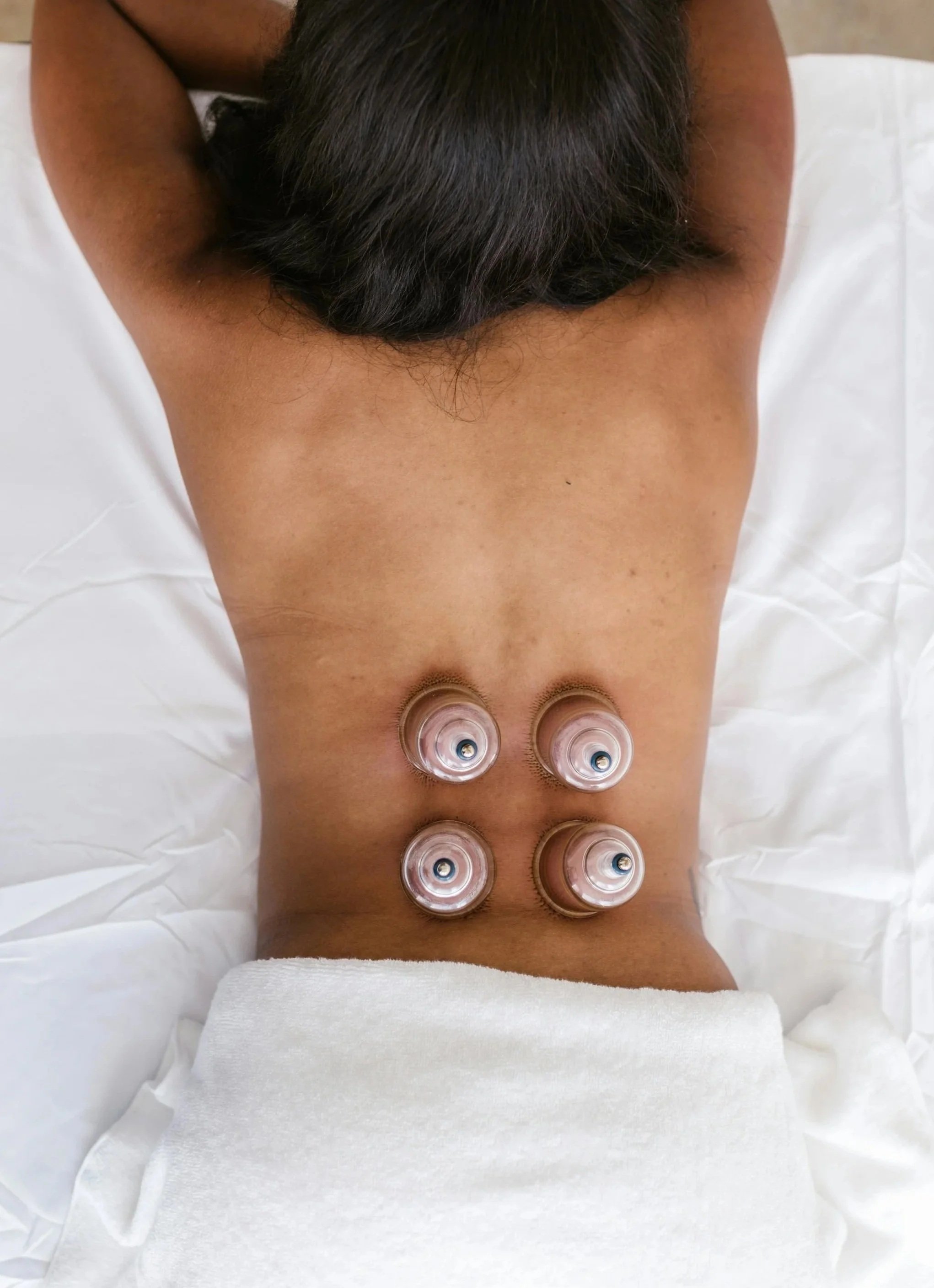 A person receiving cupping therapy on their back with four glass cups placed in a row.