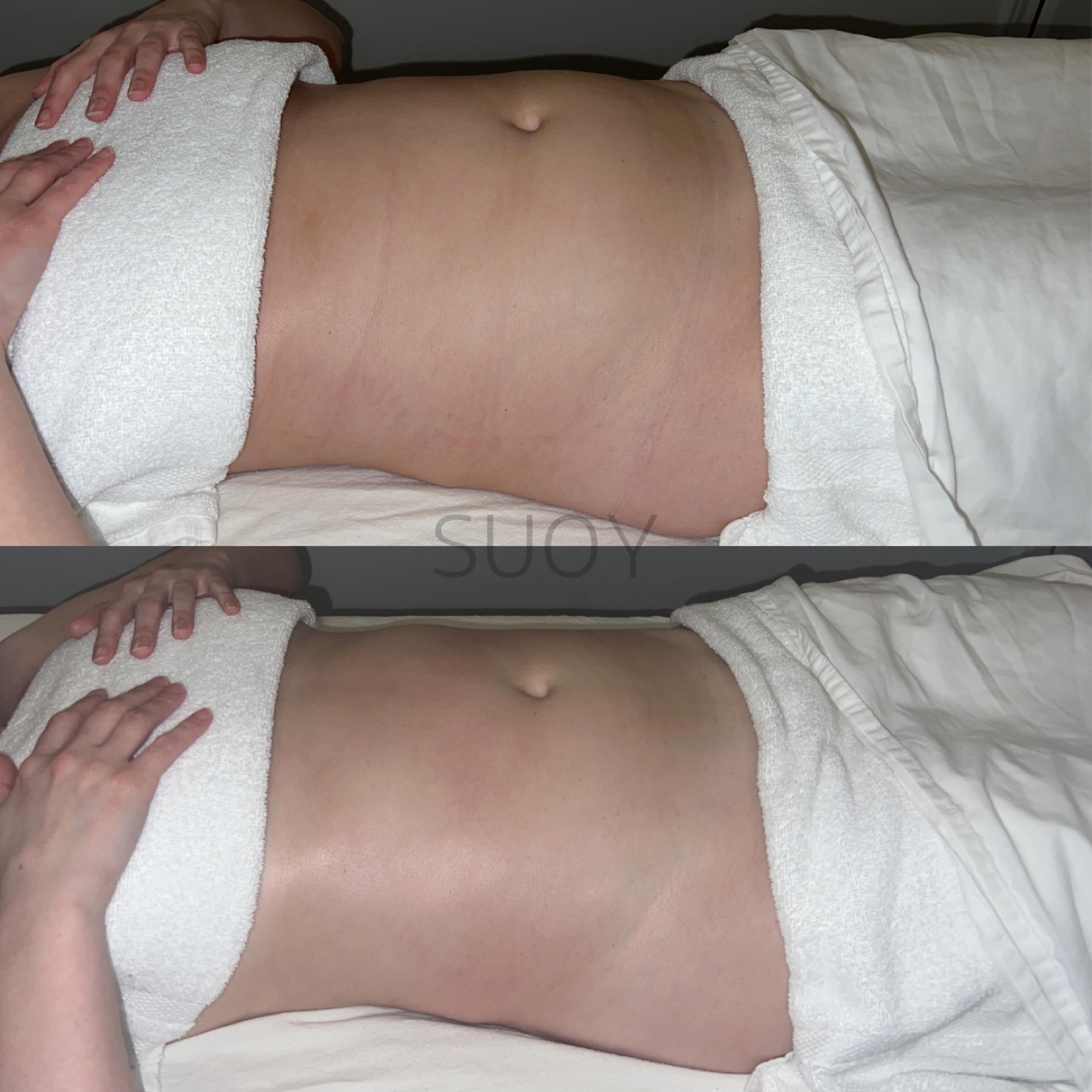 Brazilian Body Lymphatic Drainage Massage and Sculpting with techniques taught by Celebrity RMT Josie Rushing. 

Look what 50MINS can do! Top is before, bottom is after. 

We work on the WHOLE body! For us, this is more for health benefits than it is
