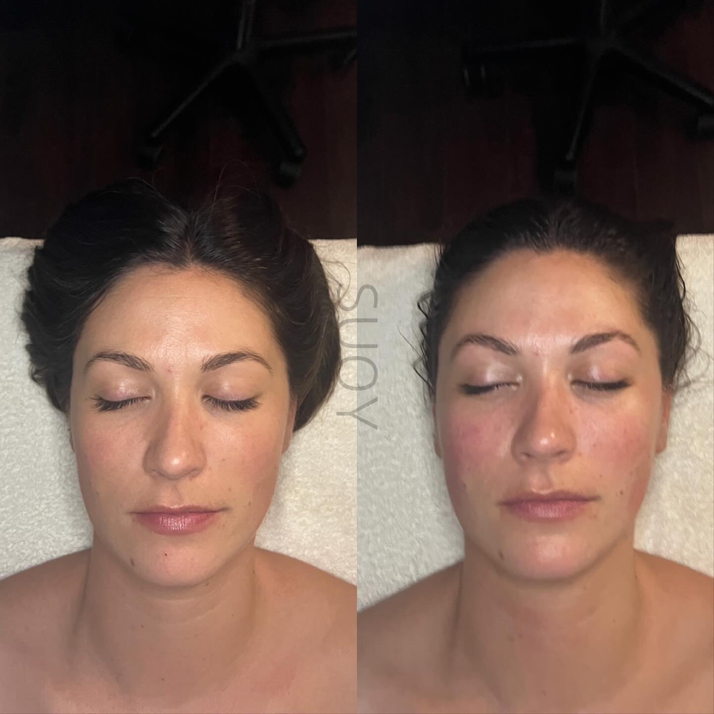 Same person, just 45mins apart! 

Everyone can benefit from a quick 45MINs Flow + Glow facial.

Left is before, Right is after. Top is before. Bottom is after. Look at the plump! Look at the lift. Sometimes we don&rsquo;t believe it ourselves!

-Lymp