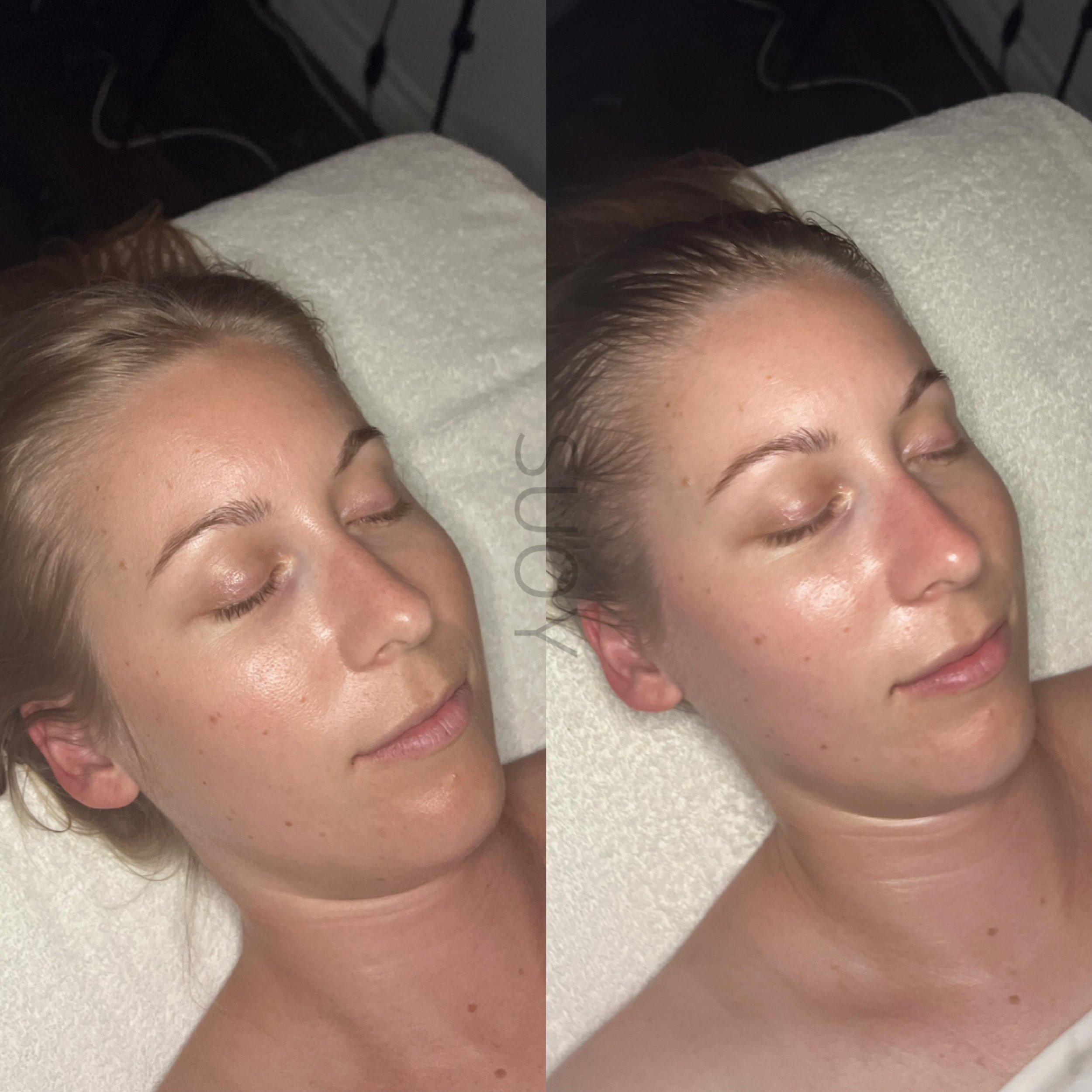 Same person, just 45mins apart!

Everyone can benefit from a quick 45MINs Flow + Glow facial.

Left is before, Right is after.  Look at the plump! Look at the lift. Sometimes we don&rsquo;t believe it ourselves!

-Lymph drainage to de puff.
-Sculptin