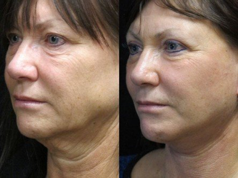 Facelift, Platysmaplasty, and Upper Blepharoplasty