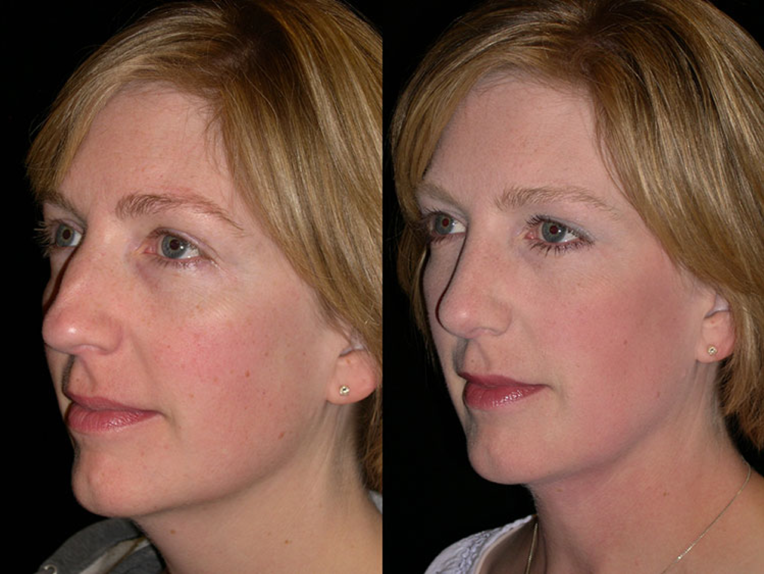Rhinoplasty