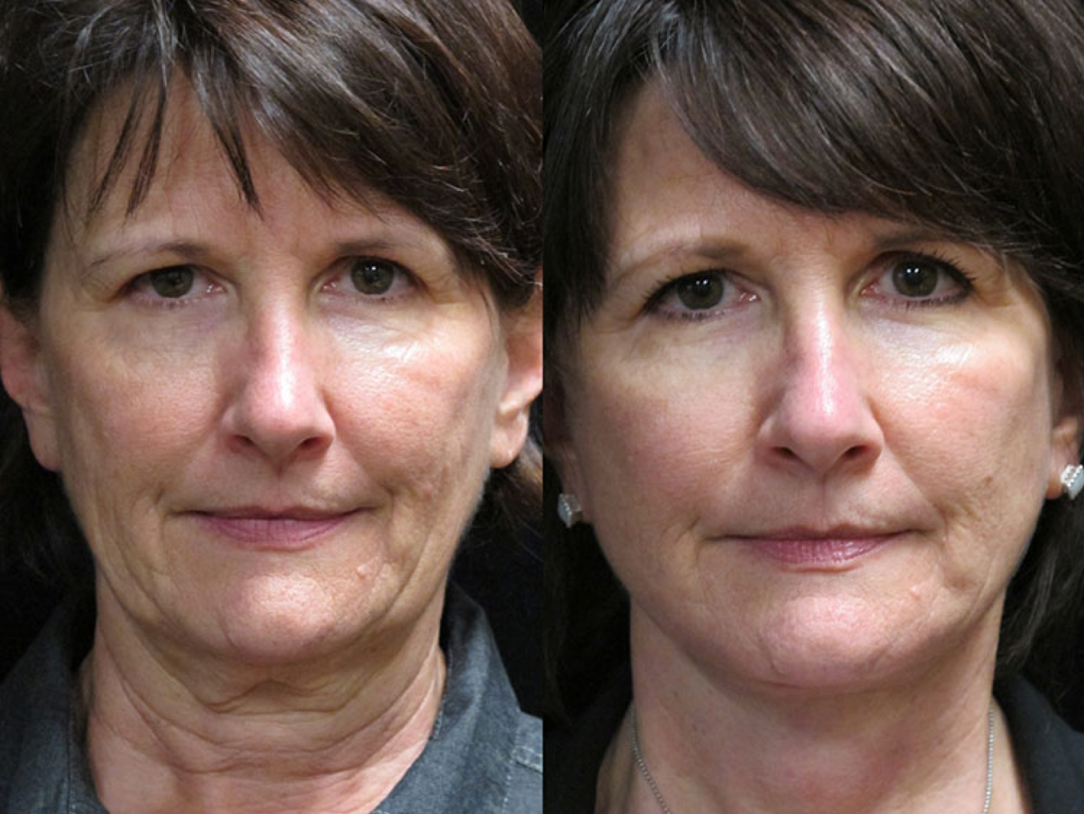 Facelift and Platysmaplasty