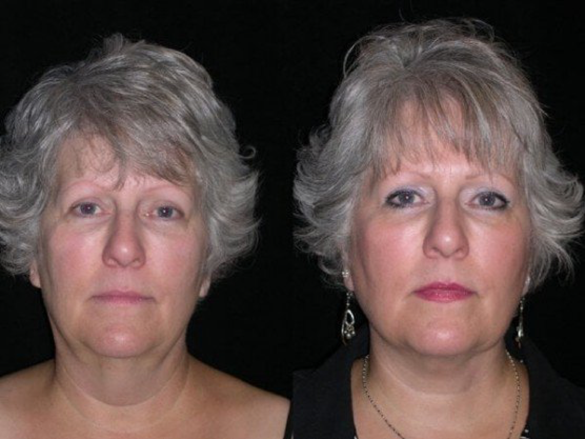 Neck Liposuction