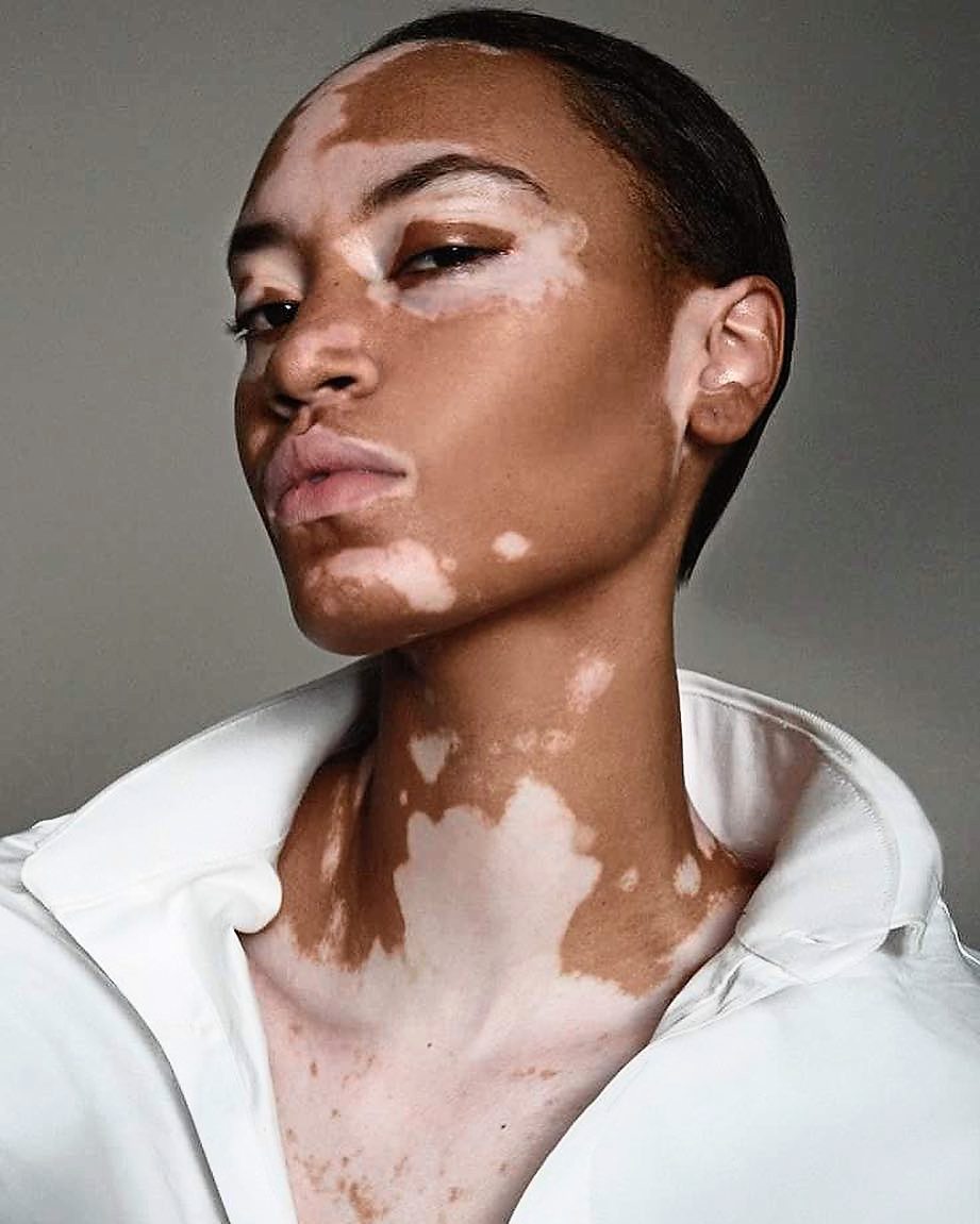 Vitiligo Revitiligo