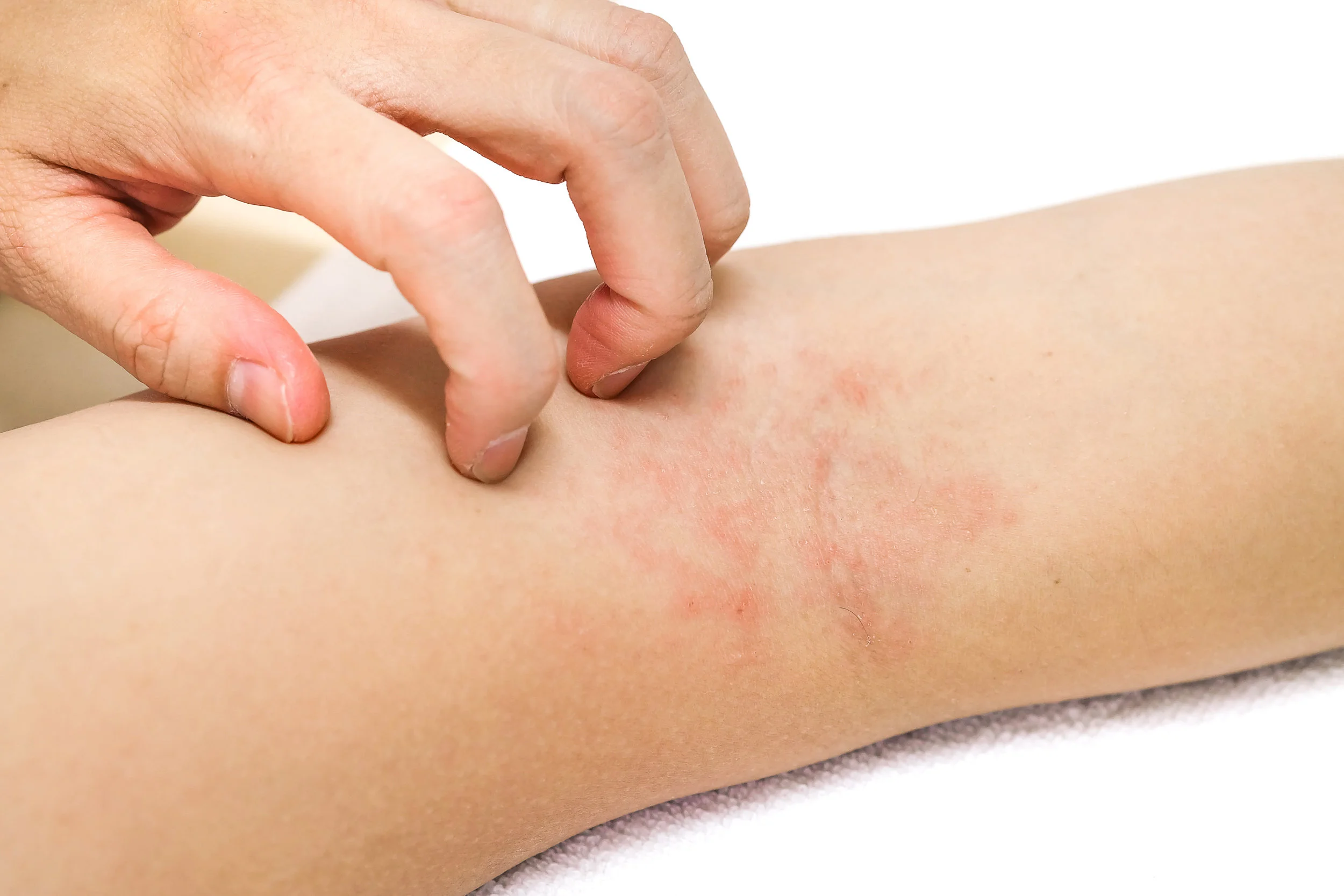 rosacea-rashes-2.jpg