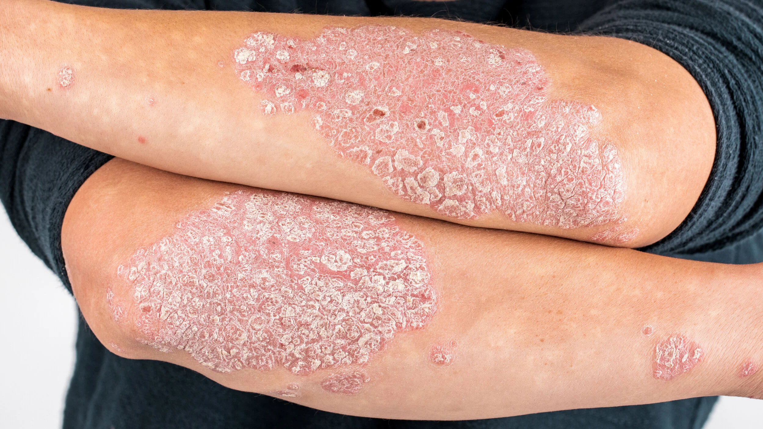 Psoriasis Skin Lesions Pictures PSFLM