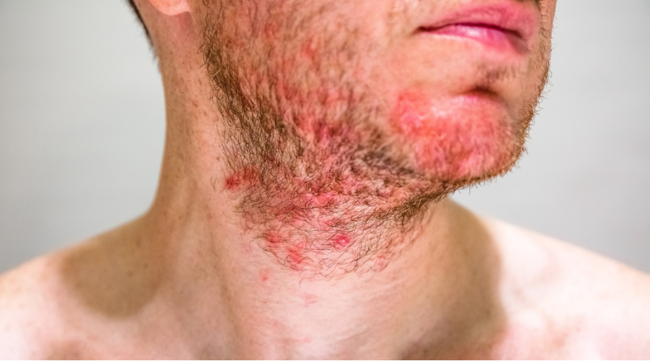 Folliculitis: When You Shouldn't Ignore Those Red Bumps — New River  Dermatology