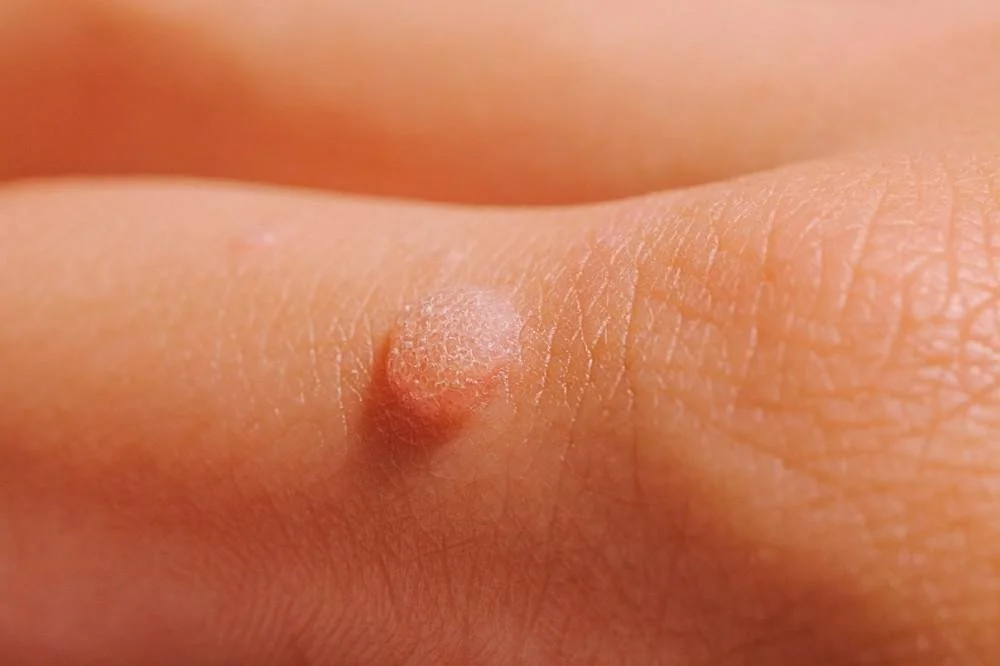 Warts Common Causes, Home Remedies, and When to See a Dermatologist