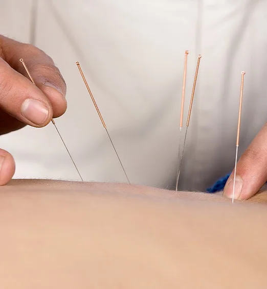 Acupuncture.jpg