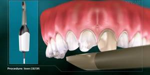 Veneers (CAD/CAM)