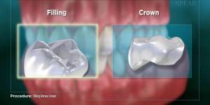 Procedure: Filling Versus Crown