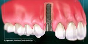 Procedure: Single Implant (Anterior Healing-Cap)