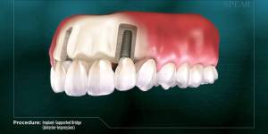 Procedure: Implant-Supported Bridge (Anterior- Impression)