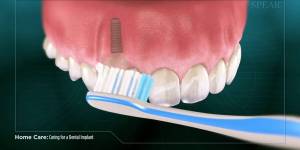 Home Care: Caring for A Dental Implant