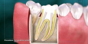 Root Canal with Post-Core Buildup