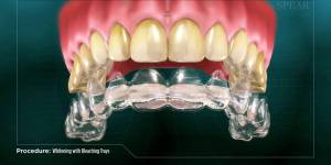 Whitening with Bleaching Trays