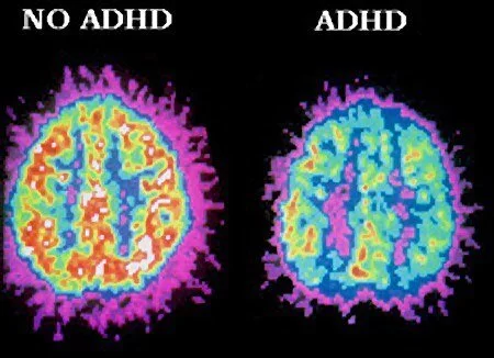 spolier alert: ADHD is a real, very serious, neurodevelopmental condition