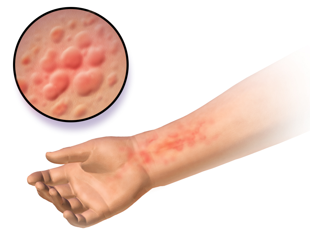 Urticaria Hives Hamilton Allergy