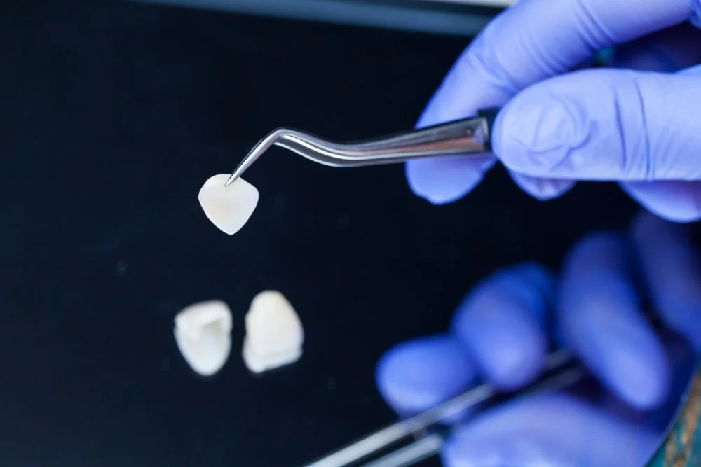 How Long Do Dental Veneers Last? 
