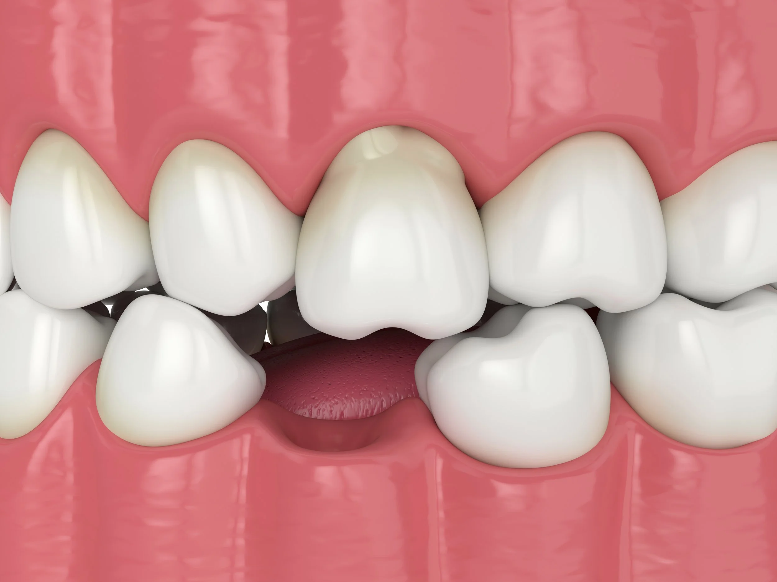 What are dry sockets? | Perry Dental & Perry Dental Kids