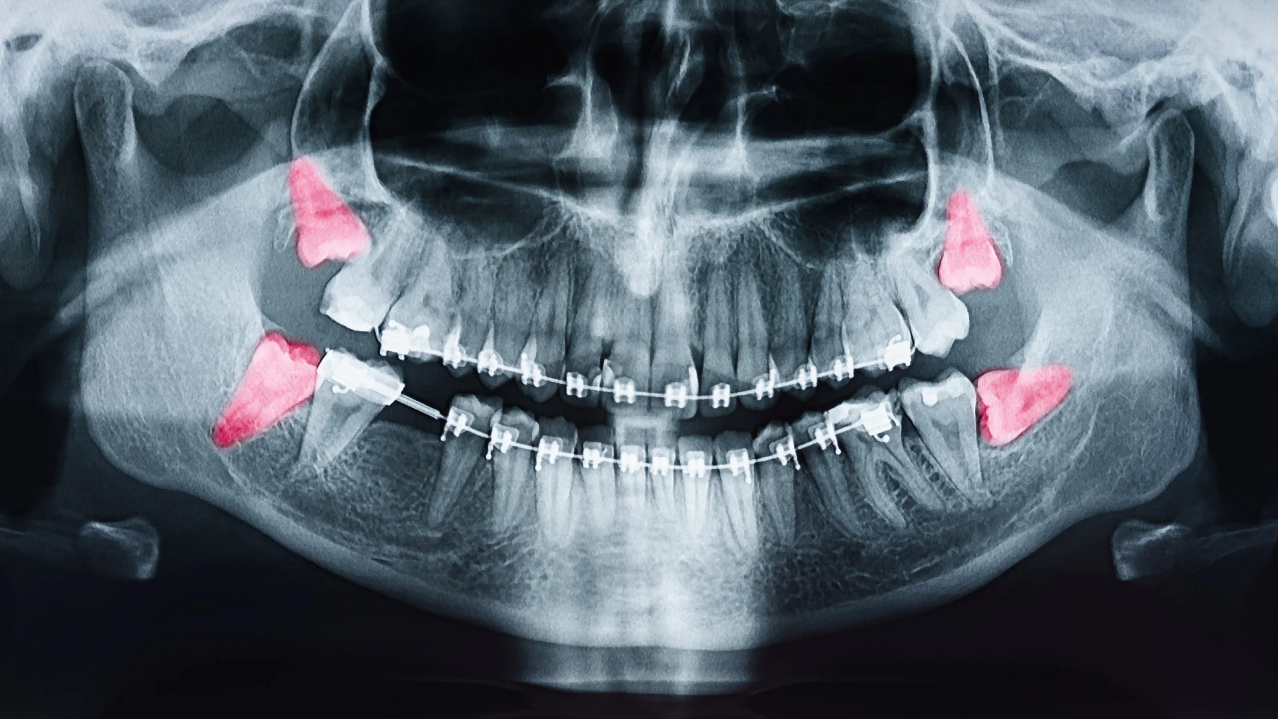 Do All Wisdom Teeth Need to Be Removed?