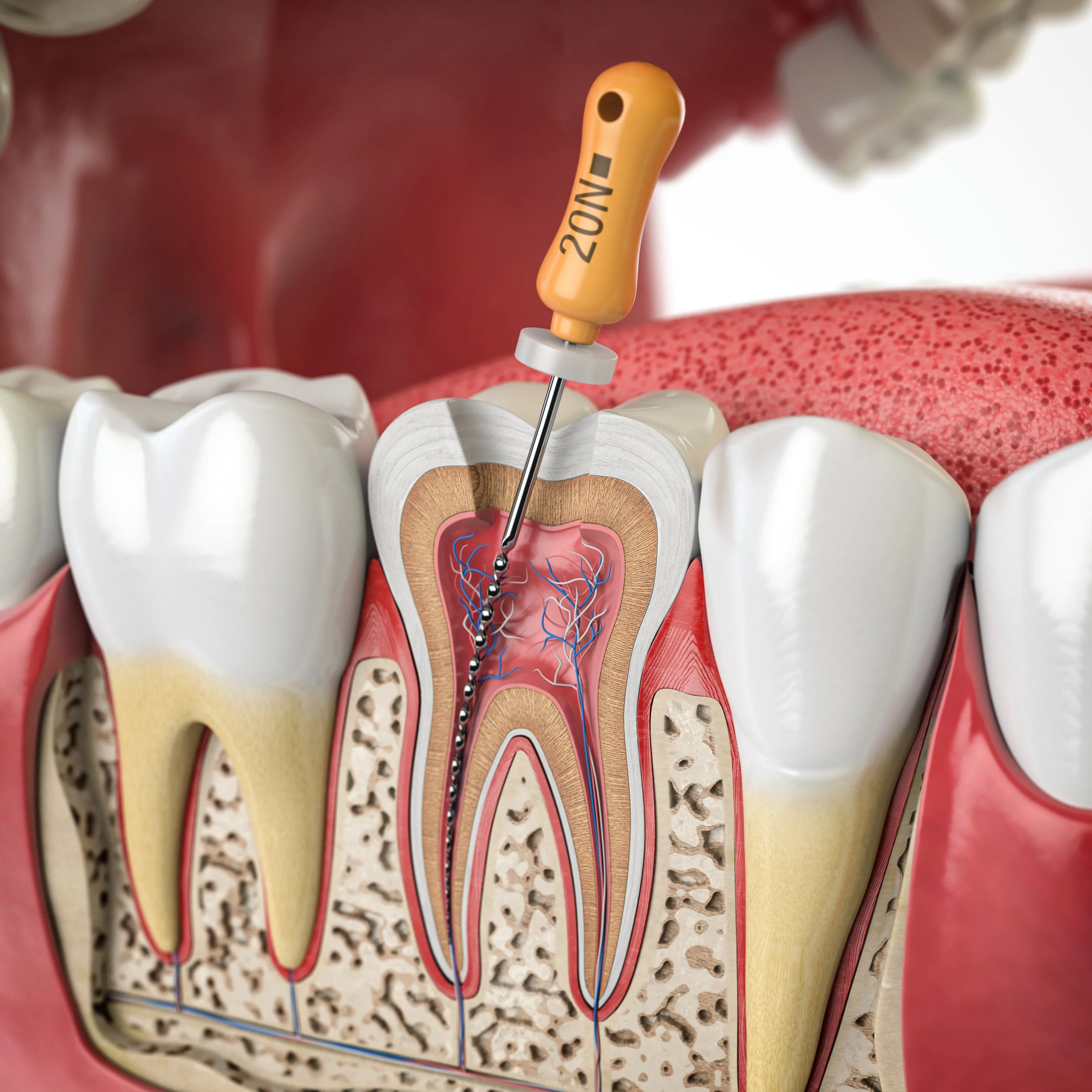 What to Expect During Root Canal Treatment.