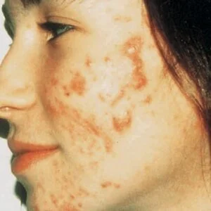 acne micro.jpg